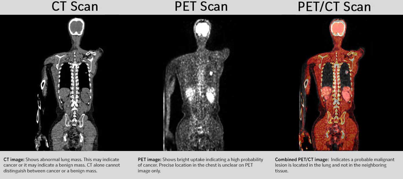 CT Scan vs MRI vs PET/CT Scan