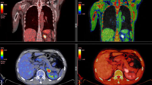 PET/CT Scan results in Oklahoma